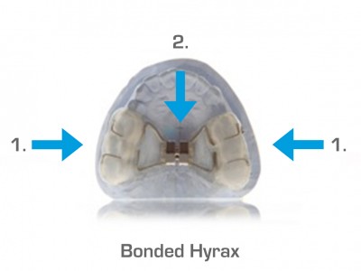 Bonded Hyrax (Geplakte Beugel) | 1. De beugel laat links of rechts los. Dit is merkbaar doordat de beugel in de mond te bewegen is. 2. De beugel is ingegroeid en sterk ontstoken aan het gehemelte. In beide gevallen het noodnummer bellen.